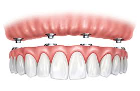 Dental Implants